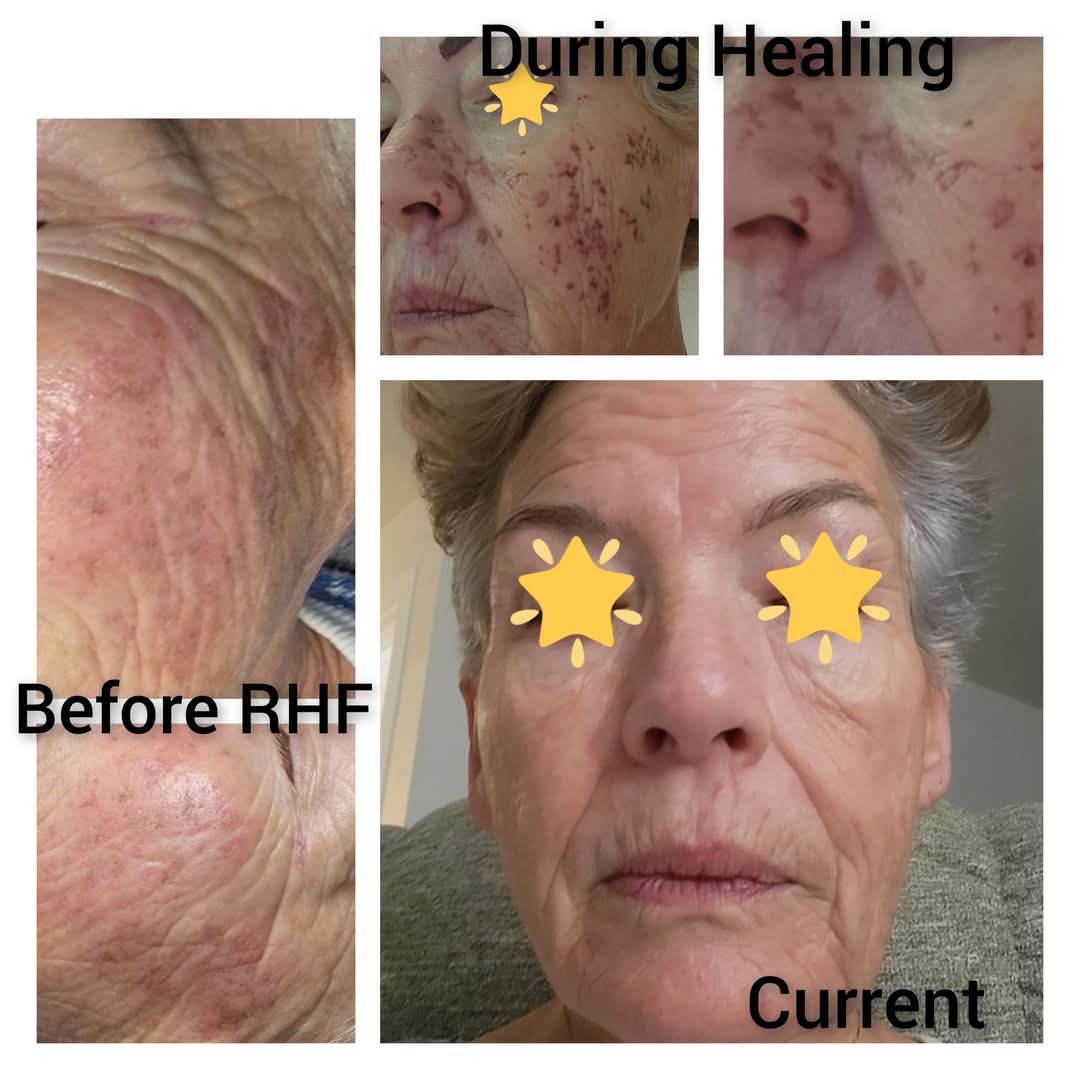 ⚡️Flash Sale-10 Min RHF Session
